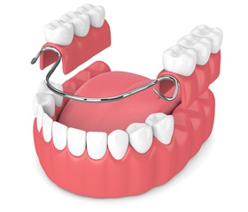 Model of partial dentures