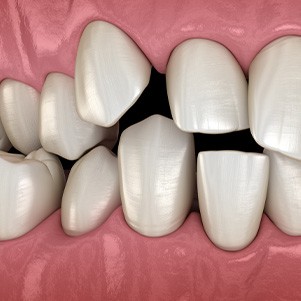 Illustration of spaced-out teeth