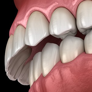 Illustration of overbite