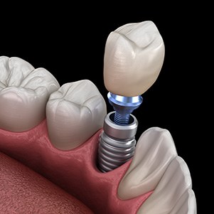 Illustration of a crown being attached to a dental implant in Port Orange