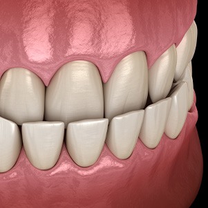 Illustration of an underbite