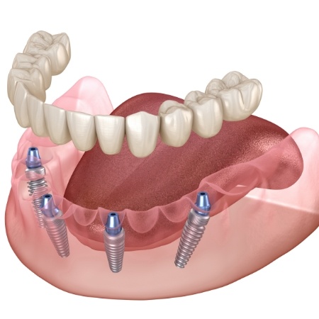 Illustration of All on 4 dental implants in Port Orange