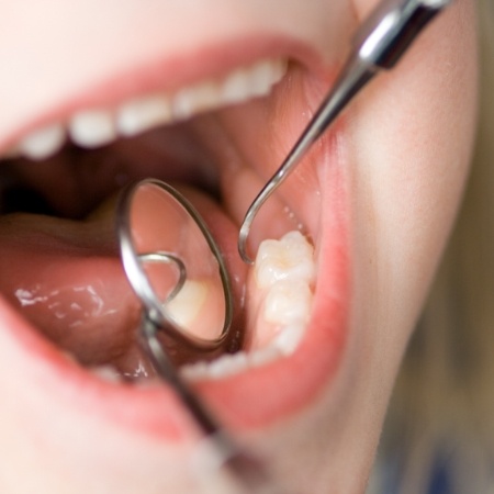 Checking teeth with dental mirror