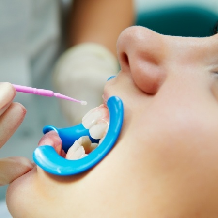 Child receiving silver diamine fluoride treatment