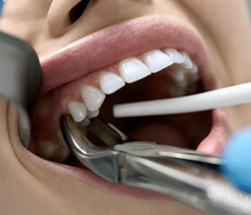 Closeup of a mouth having a tooth removed with forceps