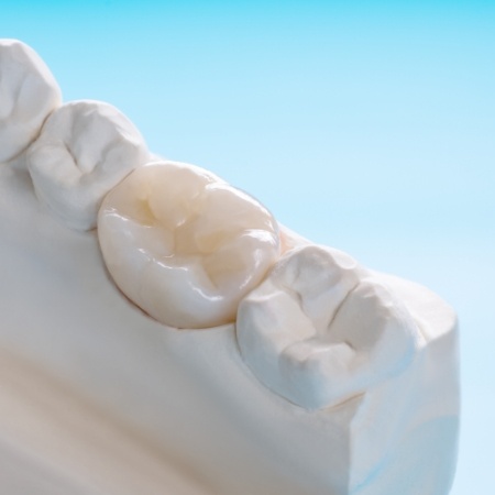 Dental crown in model of the mouth