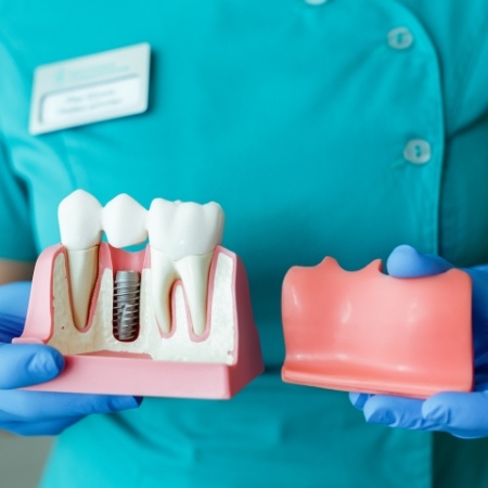 Holding model of dental implant and gums