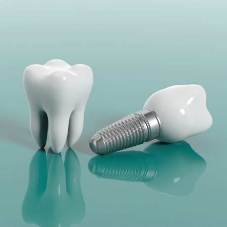 Illustration of tooth next to dental implant