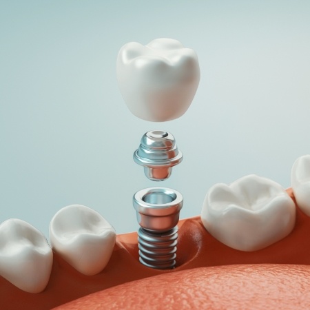 Illustration of dental implant in Port Orange with abutment and crown