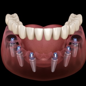 Six dental implants and full denture for lower arch