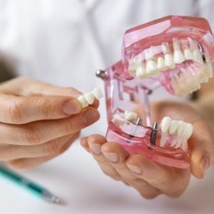 Holding model of mouth with dental implants and bridge