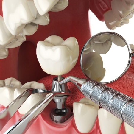 Dental implant being placed in lower arch