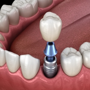 Single dental implant and crown for lower jaw