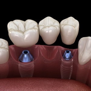 Two dental implants and a bridge