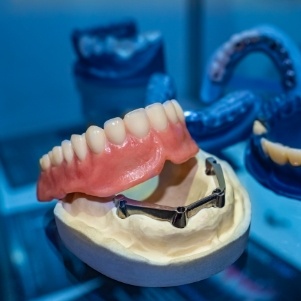 Model of implant dentures in dental office