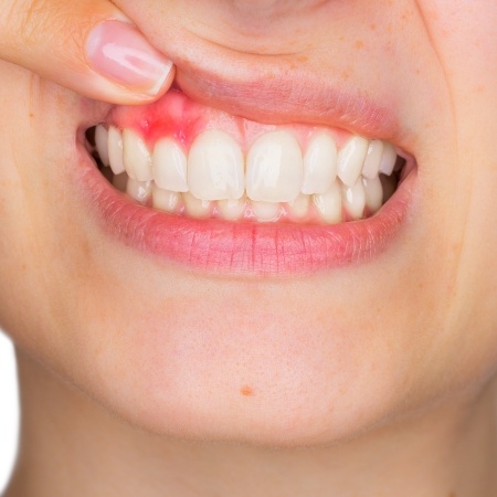 Showing inflamed gums in need of gum disease treatment in Port Orange