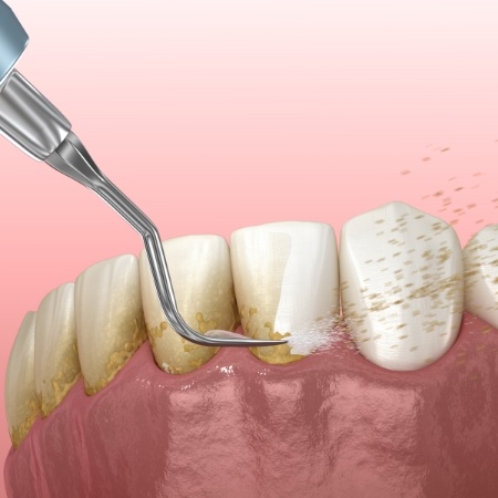 Illustration of scaling and root planing being performed