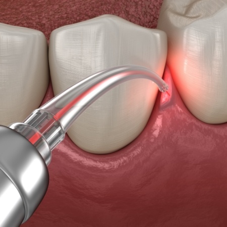 Illustration of laser being used to treat gums