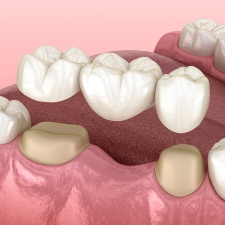 Illustration of dental bridge for replacing missing teeth in Port Orange