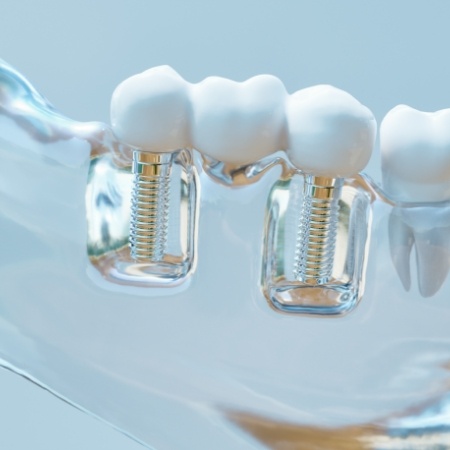 Plastic tray with dental implants and bridge