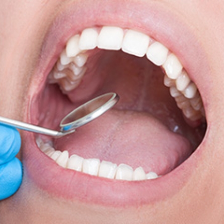 Examining smile with dental mirror