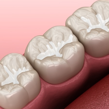Illustration of teeth with tooth colored fillings in Port Orange