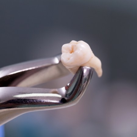 Close up of extracted tooth in forceps