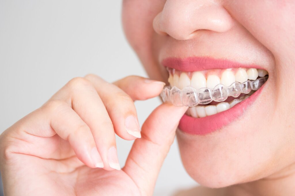 Nose-to-chin view of woman inserting her Invisalign tray